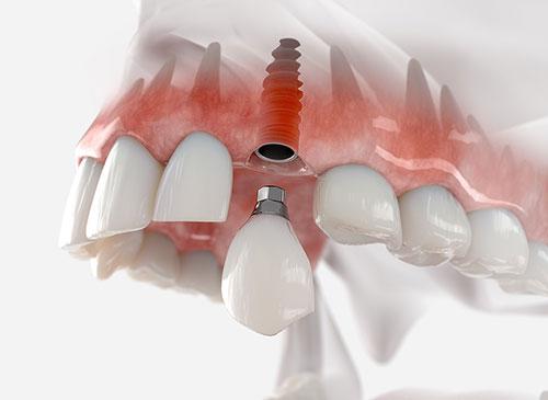 Implant et dents permanentes en 72 heures