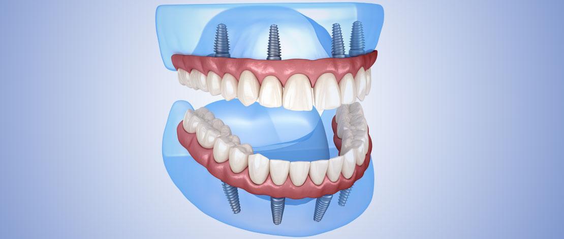 ALL-ON-4 IMPLANT